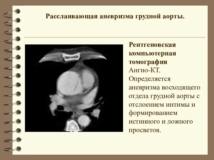 Расслаивающая аневризма грудной аорты. Рентгеновская компьютерная томография Ангио-КТ. Определяется аневризма восходящего