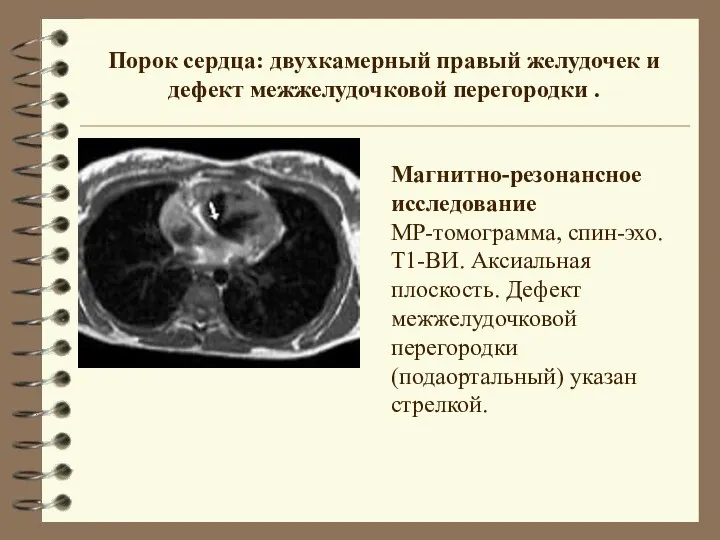 Порок сердца: двухкамерный правый желудочек и дефект межжелудочковой перегородки . Магнитно-резонансное