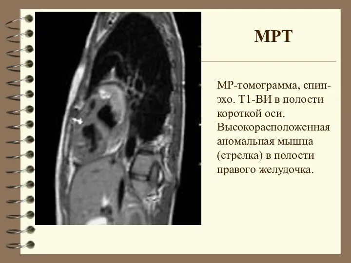 МР-томограмма, спин-эхо. Т1-ВИ в полости короткой оси. Высокорасположенная аномальная мышца (стрелка) в полости правого желудочка. МРТ