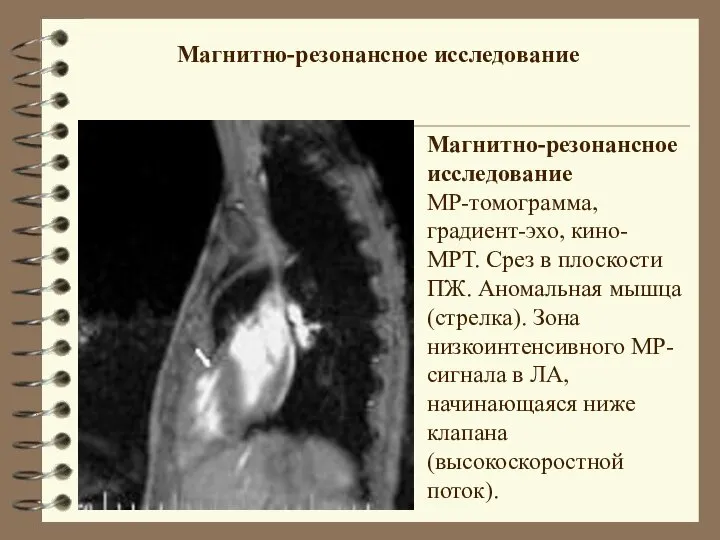 Магнитно-резонансное исследование МР-томограмма, градиент-эхо, кино-МРТ. Срез в плоскости ПЖ. Аномальная мышца