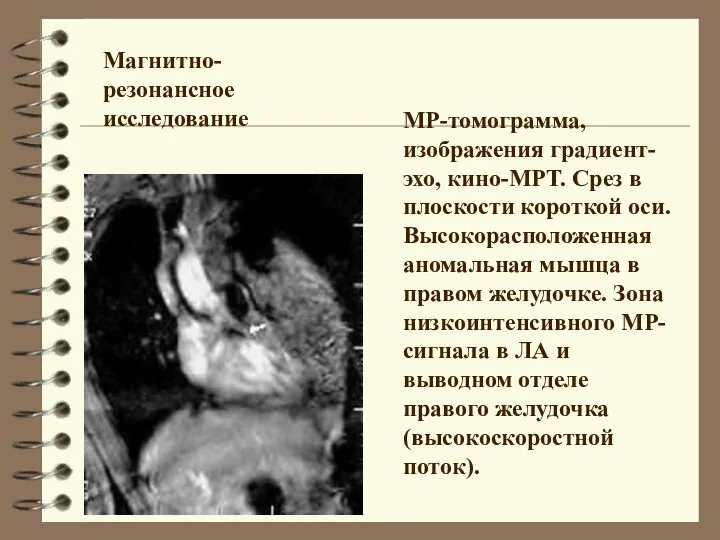 МР-томограмма, изображения градиент-эхо, кино-МРТ. Срез в плоскости короткой оси. Высокорасположенная аномальная