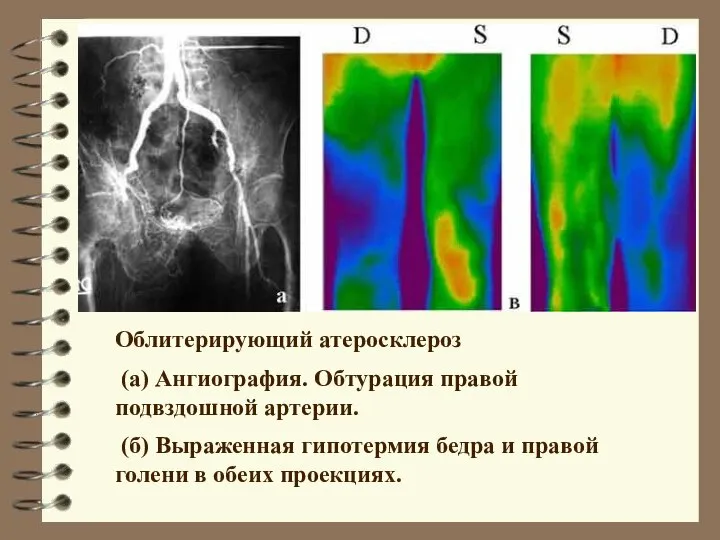 Облитерирующий атеросклероз (а) Ангиография. Обтурация правой подвздошной артерии. (б) Выраженная гипотермия