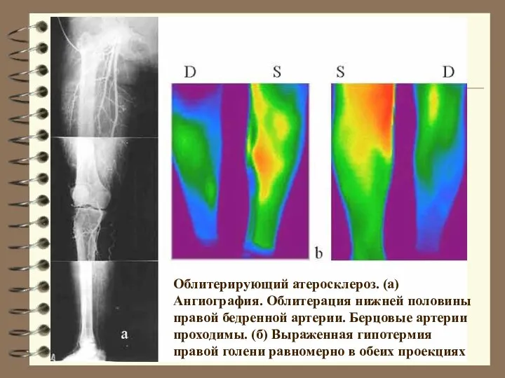 Облитерирующий атеросклероз. (а) Ангиография. Облитерация нижней половины правой бедренной артерии. Берцовые