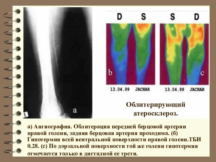 Облитерирующий атеросклероз. а) Ангиография. Облитерация передней берцовой артерии правой голени, задняя