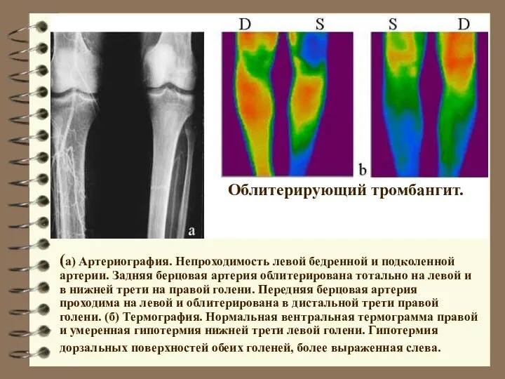 Облитерирующий тромбангит. (а) Артериография. Непроходимость левой бедренной и подколенной артерии. Задняя