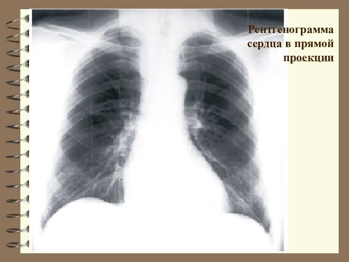 Рентгенограмма сердца в прямой проекции