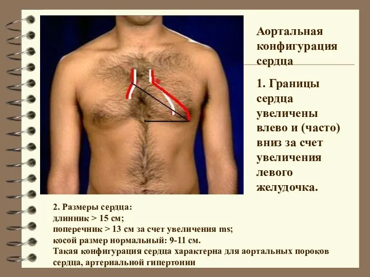 2. Размеры сердца: длинник > 15 см; поперечник > 13 см