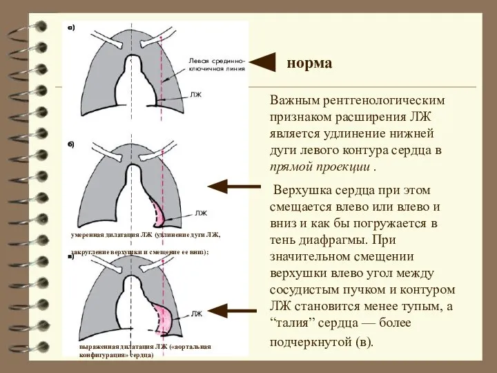 норма Важным рентгенологическим признаком расширения ЛЖ является удлинение нижней дуги левого