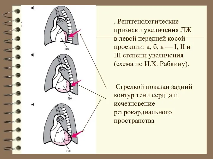 . Рентгенологические признаки увеличения ЛЖ в левой передней косой проекции: а,