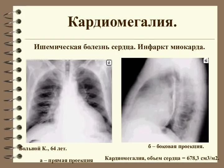 Кардиомегалия. Ишемическая болезнь сердца. Инфаркт миокарда. Больной К., 64 лет. а