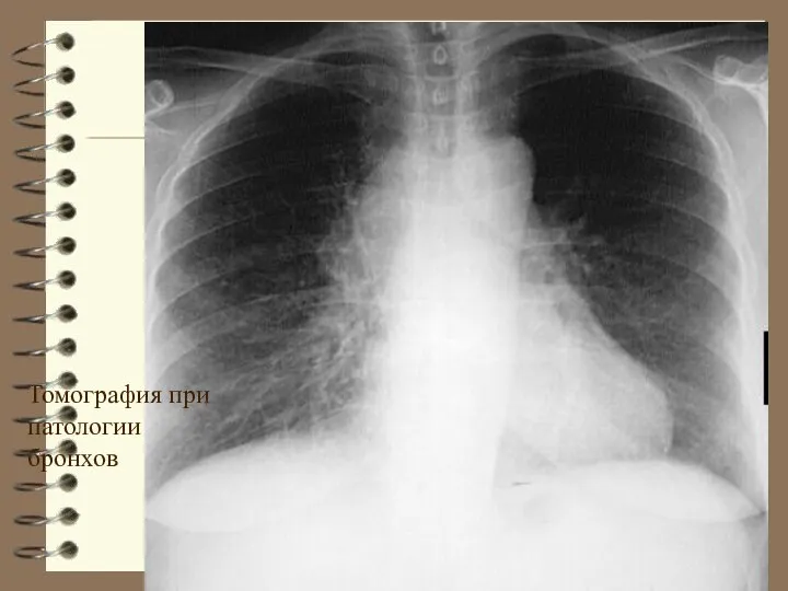 Томография при патологии бронхов