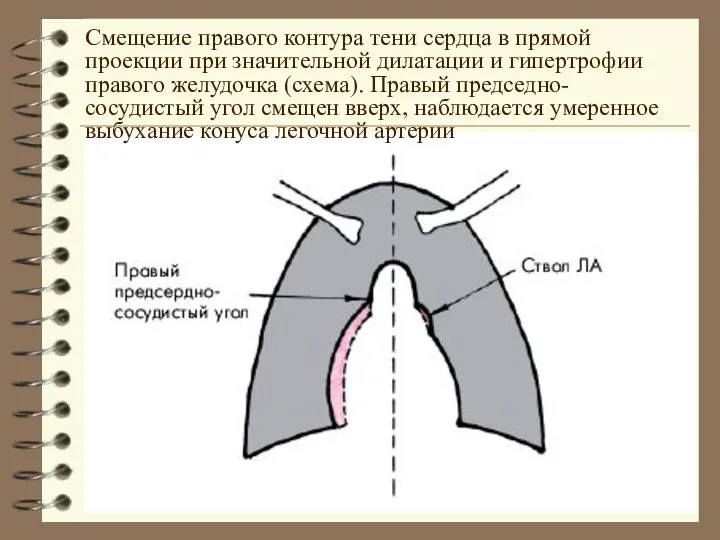 Смещение правого контура тени сердца в прямой проекции при значительной дилатации