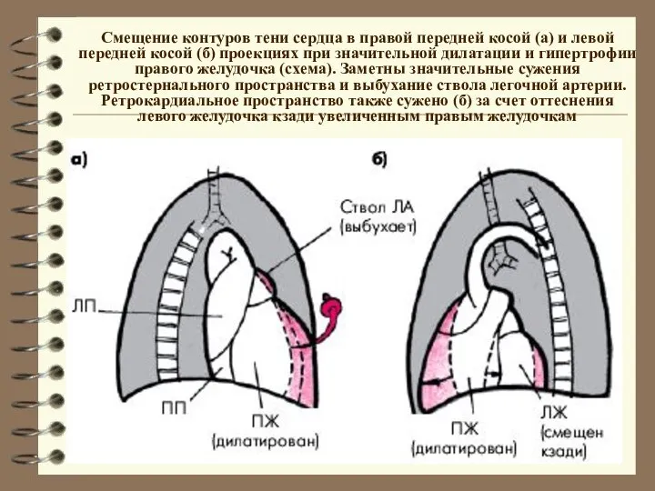 Смещение контуров тени сердца в правой передней косой (а) и левой