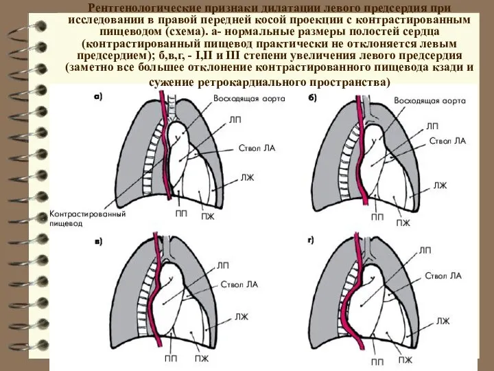 Рентгенологические признаки дилатации левого предсердия при исследовании в правой передней косой