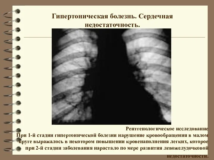 Гипертоническая болезнь. Сердечная недостаточность. Рентгенологическое исследование При 1-й стадии гипертонической болезни