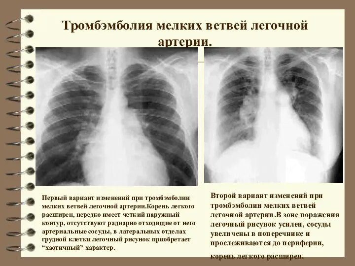 Тромбэмболия мелких ветвей легочной артерии. Первый вариант изменений при тромбэмболии мелких