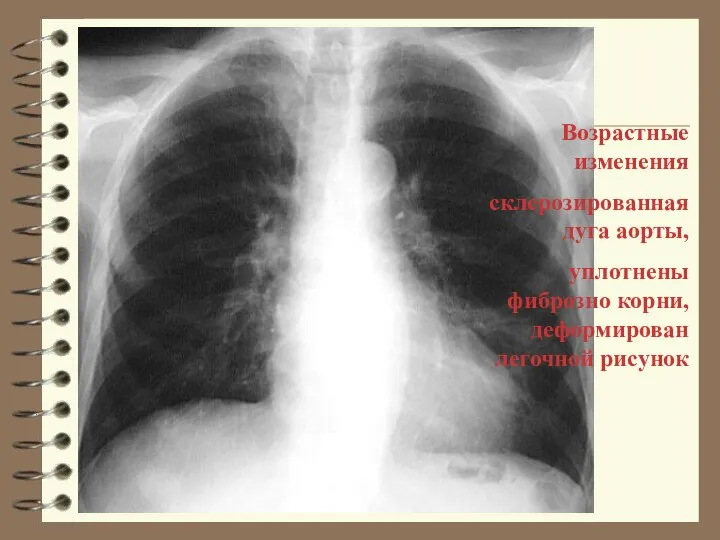 Возрастные изменения склерозированная дуга аорты, уплотнены фиброзно корни, деформирован легочной рисунок