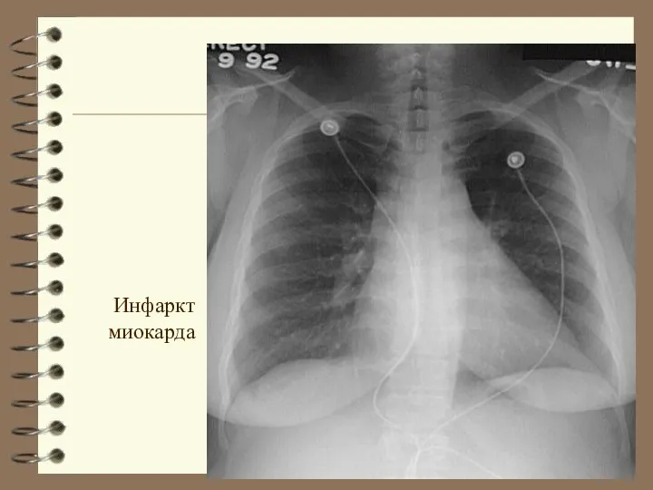 Инфаркт миокарда