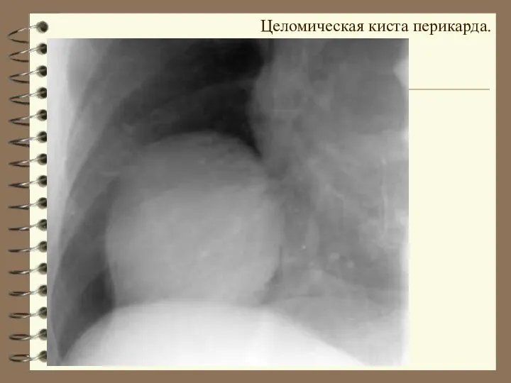 Целомическая киста перикарда.