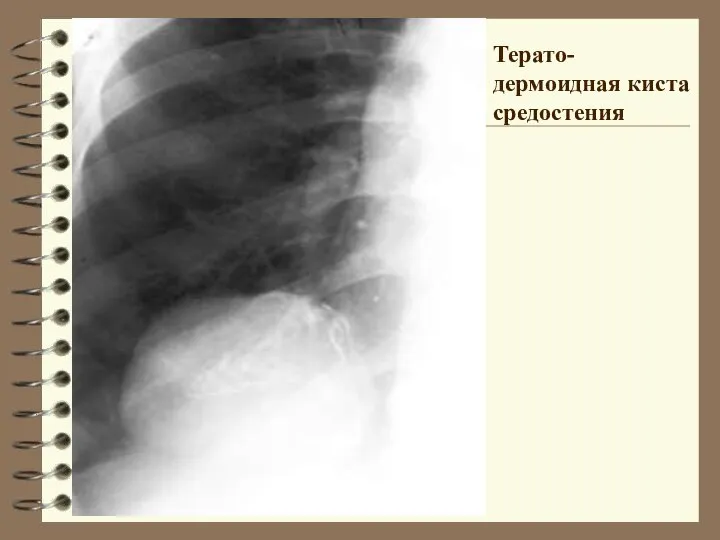 Терато-дермоидная киста средостения