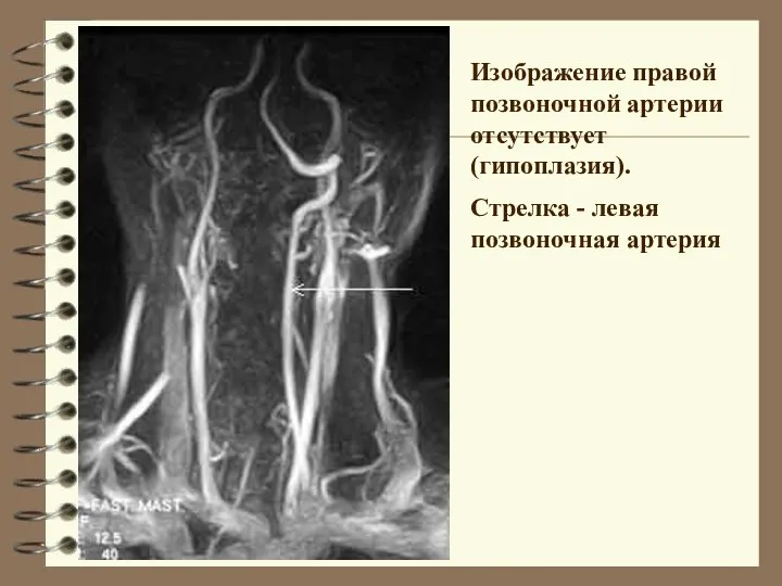 Изображение правой позвоночной артерии отсутствует (гипоплазия). Стрелка - левая позвоночная артерия