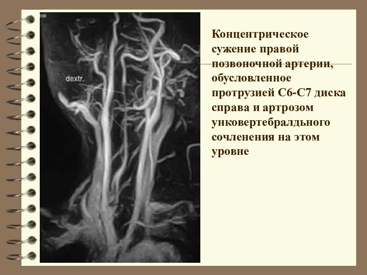 Концентрическое сужение правой позвоночной артерии, обусловленное протрузией С6-С7 диска справа и