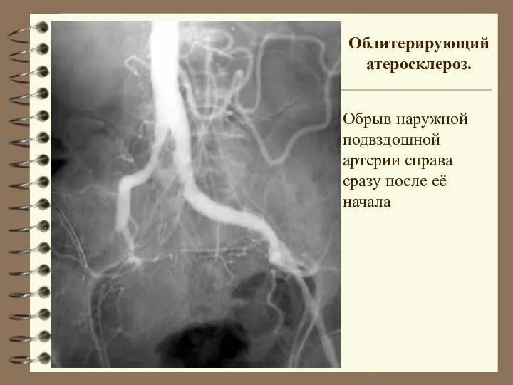 Облитерирующий атеросклероз. Обрыв наружной подвздошной артерии справа сразу после её начала