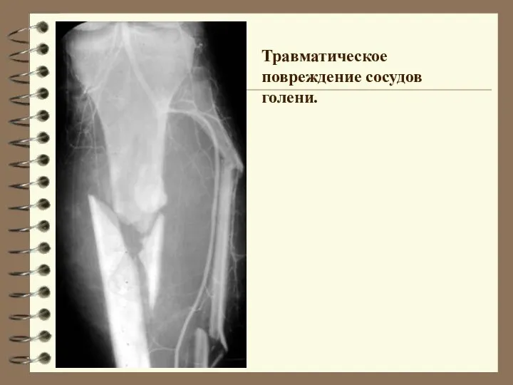 Травматическое повреждение сосудов голени.