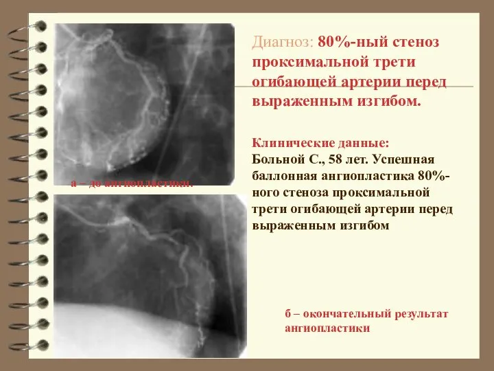 Клинические данные: Больной С., 58 лет. Успешная баллонная ангиопластика 80%-ного стеноза