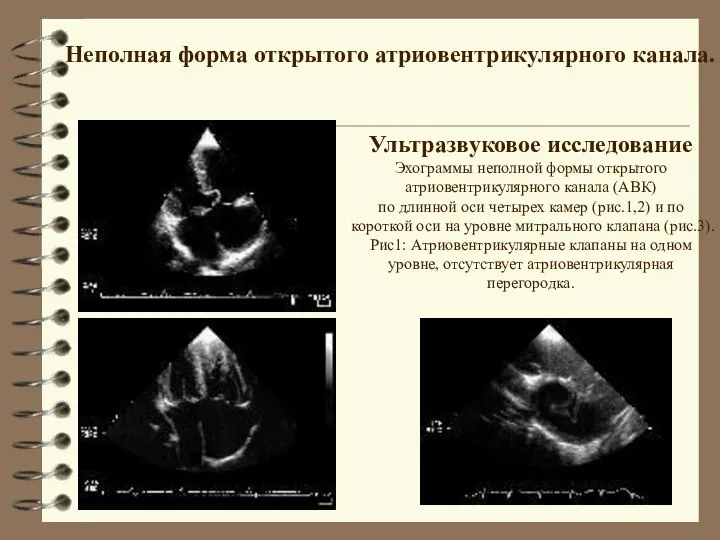 Ультразвуковое исследование Эхограммы неполной формы открытого атриовентрикулярного канала (АВК) по длинной