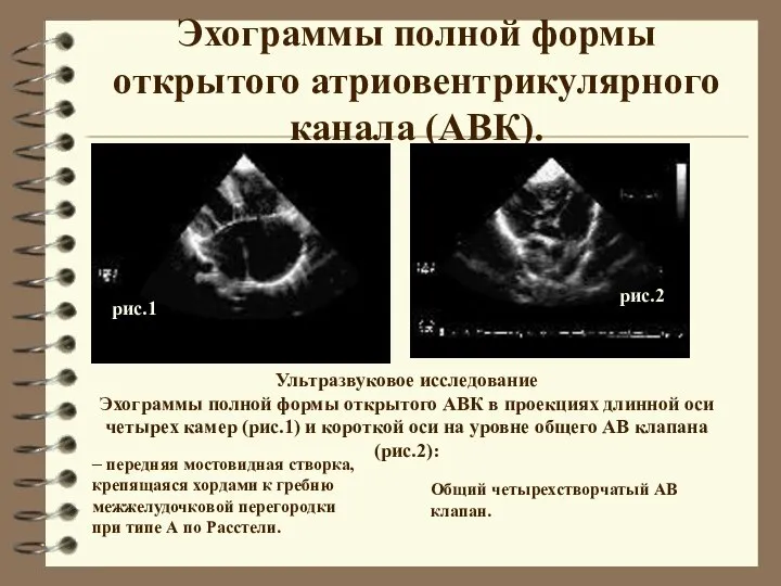 Эхограммы полной формы открытого атриовентрикулярного канала (АВК). Ультразвуковое исследование Эхограммы полной