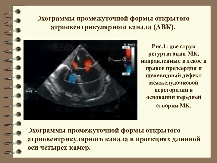 Эхограммы промежуточной формы открытого атриовентрикулярного канала (АВК). Эхограммы промежуточной формы открытого