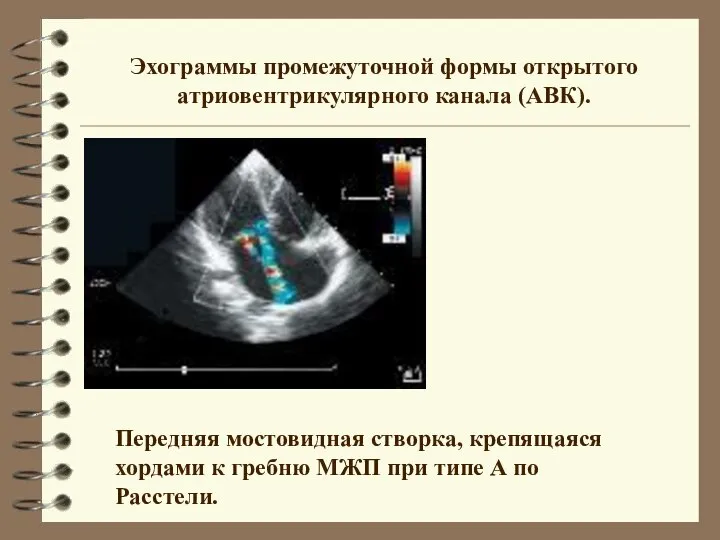 Передняя мостовидная створка, крепящаяся хордами к гребню МЖП при типе А