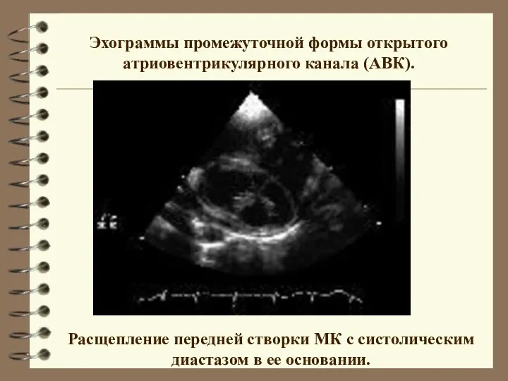 Эхограммы промежуточной формы открытого атриовентрикулярного канала (АВК). Расщепление передней створки МК