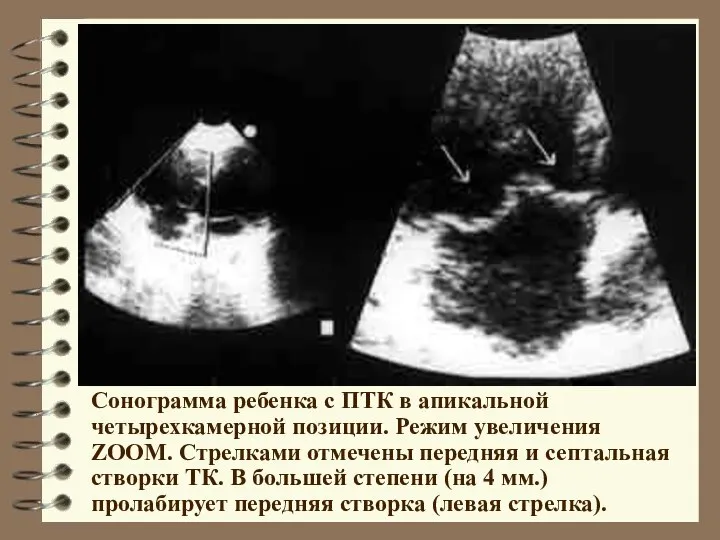 Сонограмма ребенка с ПТК в апикальной четырехкамерной позиции. Режим увеличения ZOOM.