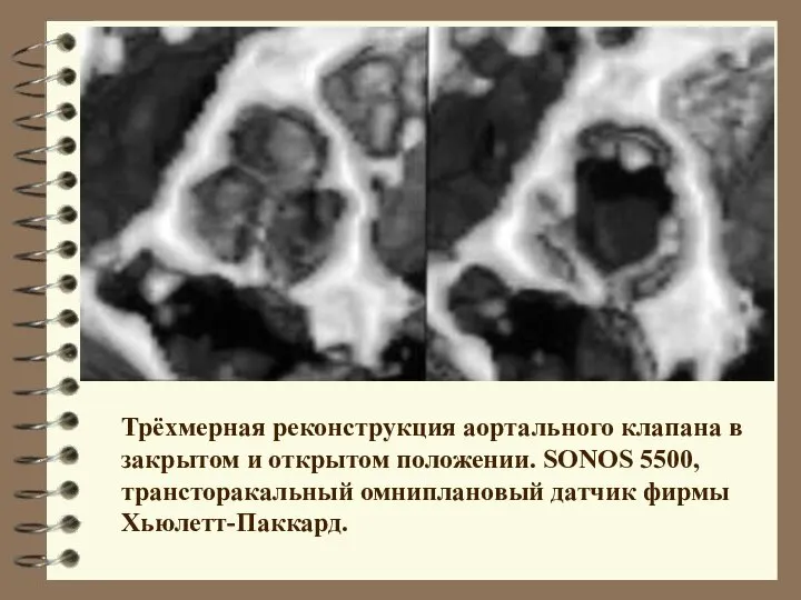 Трёхмерная реконструкция аортального клапана в закрытом и открытом положении. SONOS 5500, трансторакальный омниплановый датчик фирмы Хьюлетт-Паккард.