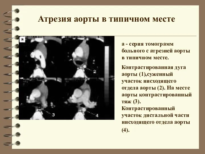 Атрезия аорты в типичном месте а - серия томограмм больного с