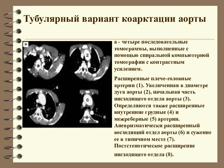 Тубулярный вариант коарктации аорты а - четыре последовательные томограммы, выполненные с