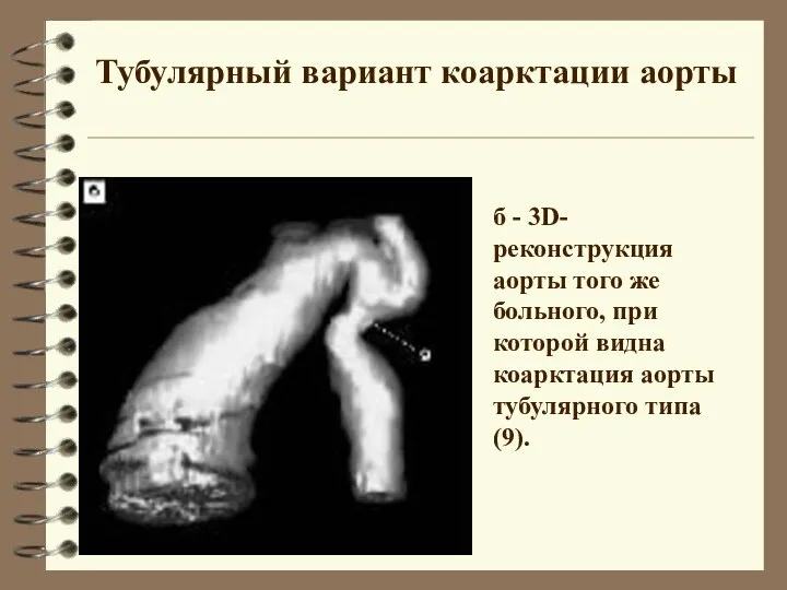 б - 3D-реконструкция аорты того же больного, при которой видна коарктация