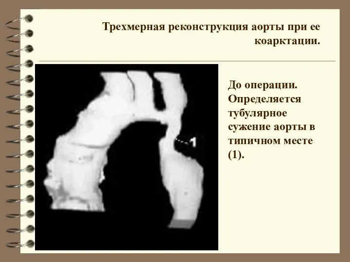 Трехмерная реконструкция аорты при ее коарктации. До операции. Определяется тубулярное сужение аорты в типичном месте (1).