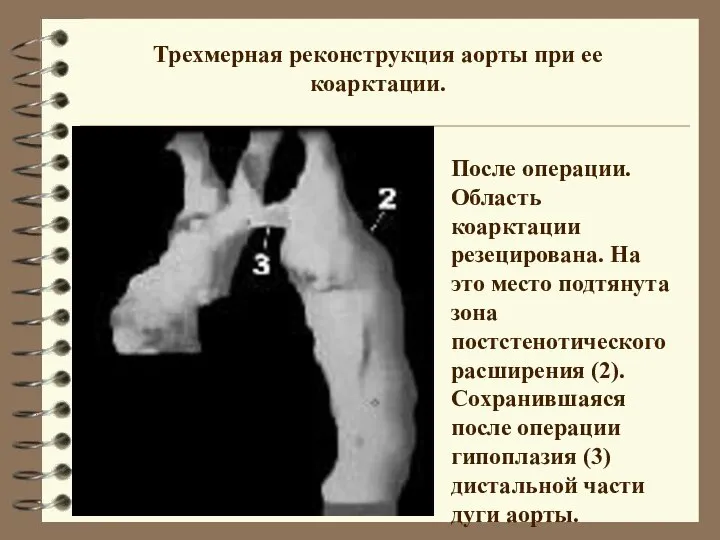 После операции. Область коарктации резецирована. На это место подтянута зона постстенотического