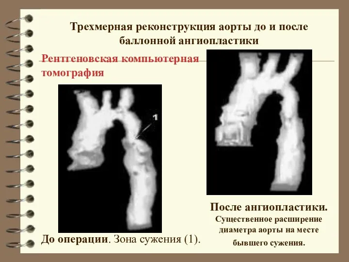 Трехмерная реконструкция аорты до и после баллонной ангиопластики До операции. Зона