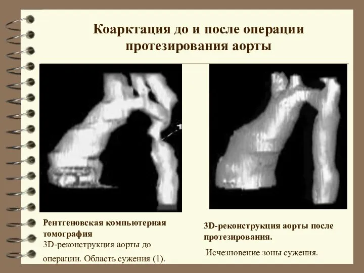 Коарктация до и после операции протезирования аорты Рентгеновская компьютерная томография 3D-реконструкция