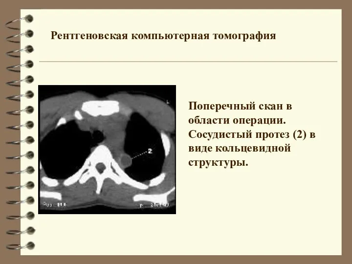 Рентгеновская компьютерная томография Поперечный скан в области операции. Сосудистый протез (2) в виде кольцевидной структуры.