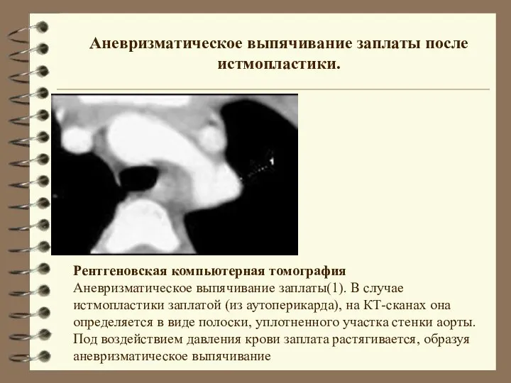 Аневризматическое выпячивание заплаты после истмопластики. Рентгеновская компьютерная томография Аневризматическое выпячивание заплаты(1).