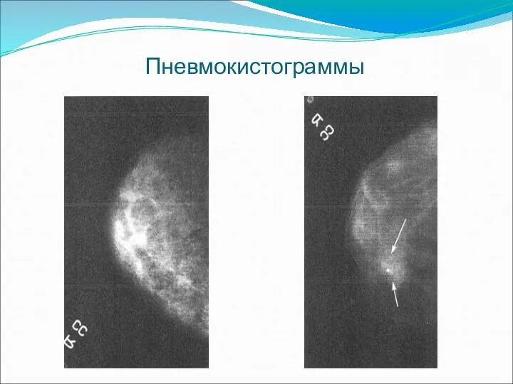 Пневмокистограммы