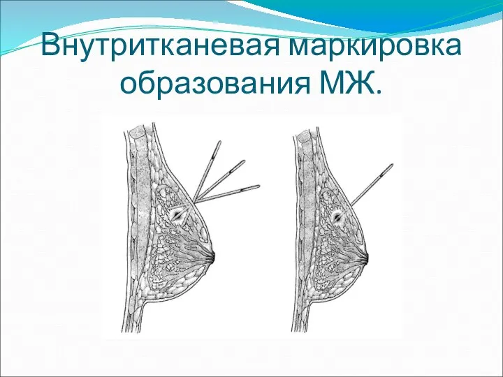 Внутритканевая маркировка образования МЖ.