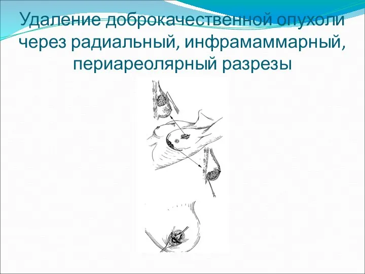 Удаление доброкачественной опухоли через радиальный, инфрамаммарный, периареолярный разрезы