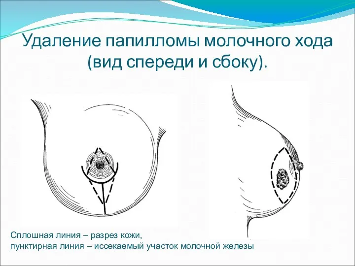 Удаление папилломы молочного хода (вид спереди и сбоку). Сплошная линия –