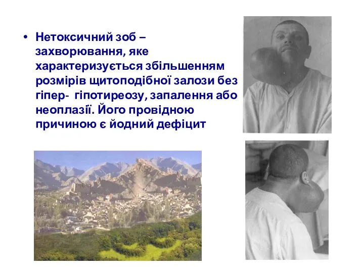 Нетоксичний зоб – захворювання, яке характеризується збільшенням розмірів щитоподібної залози без